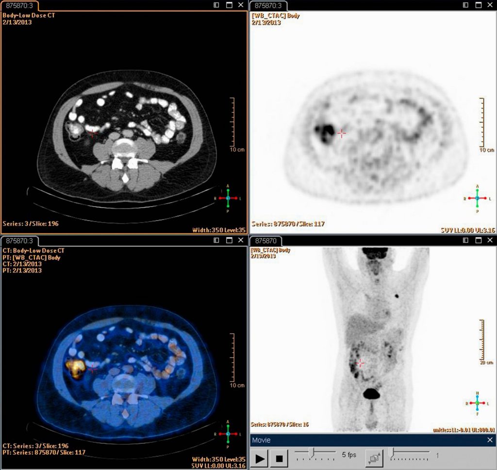 Pet Ct Scan Lymphoma