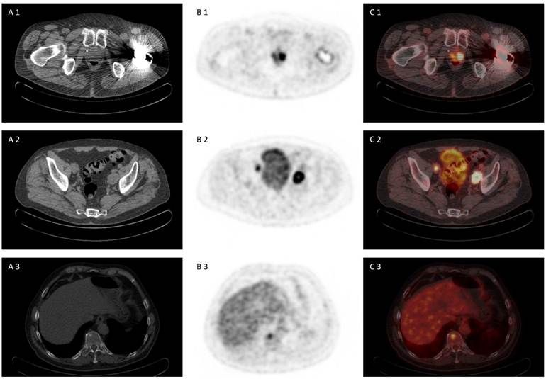 Pet Scan Lymphoma Suv