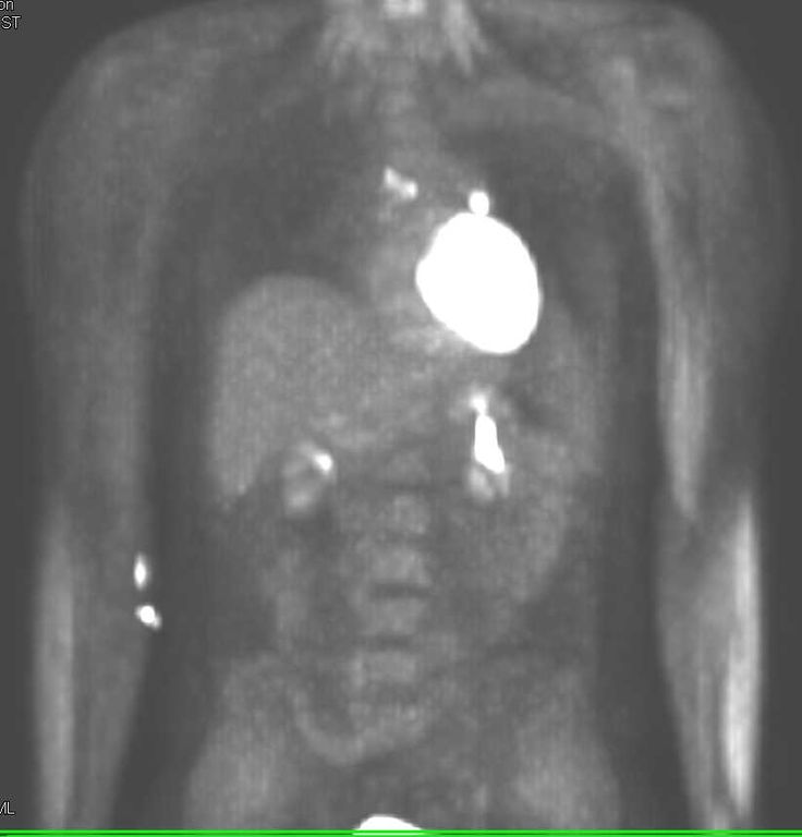 Cardiac Pet Scan Sarcoidosis